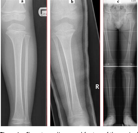 Table 1 From Trampoline Fracture Of The Proximal Tibial Metaphysis In