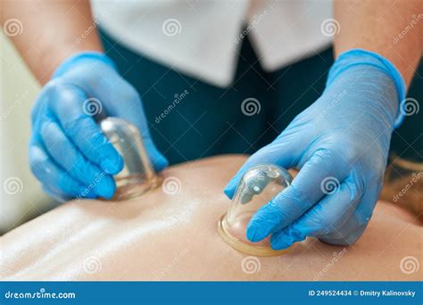 Cupping Therapy Young Female Physiotherapist Applying Glass Suction Banks On Back Of Her