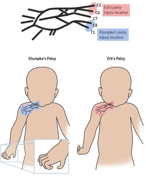 Brachial Plexus Made Easy Erbs Palsy Klumpkes Palsy Anatomy Use Images And Photos Finder
