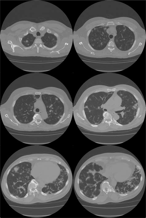 Chest X Ray Showing Bilateral Nodular Opacities In The Lungs