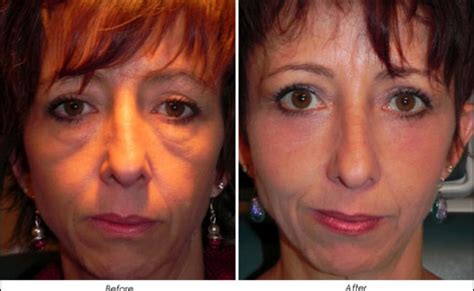 Laser Treatment For Undereye Bags And Festoons Ahb Cuitandokter