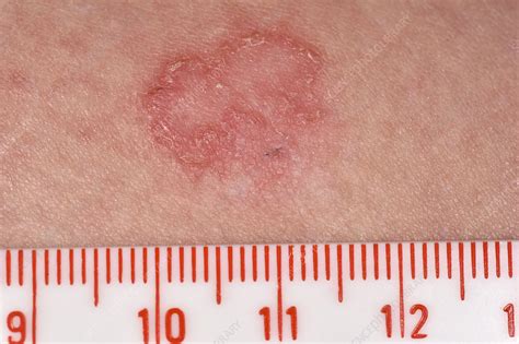 Ringworm Stock Image C0498387 Science Photo Library