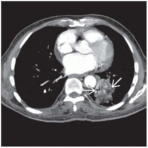 Lipoid Pneumonia Radiology Key