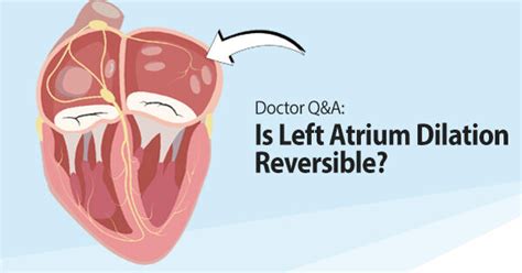 Reversing Left Atrium Dilation After Heart Valve Surgery