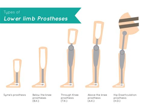 Lower Limb Prosthesis Leg Amputation Rehabilitation Propel