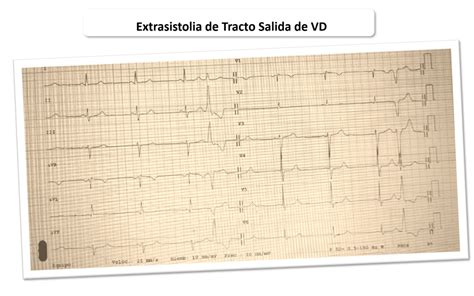 Extrasistolia Ventricular Cardioprimaria Ferrol