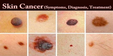 Skin Cancer Symptoms In Women