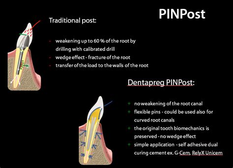 Dentapreg Pinpost Cured Elastic And Flexible Pins