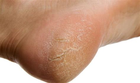 Type 2 Diabetes Symptoms Three Signs To Look Out For On Your Skin