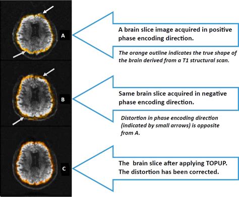 3t How To Dti Topup Distortion Correction Center For Functional Mri