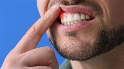 Gum Disease Causes Symptoms And Prevention Dr Elston Wong Dentistry