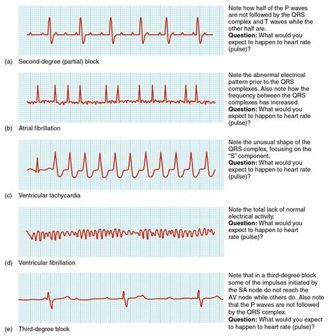Ekg List In This Image The Qt Cycle For Different Heart Conditions