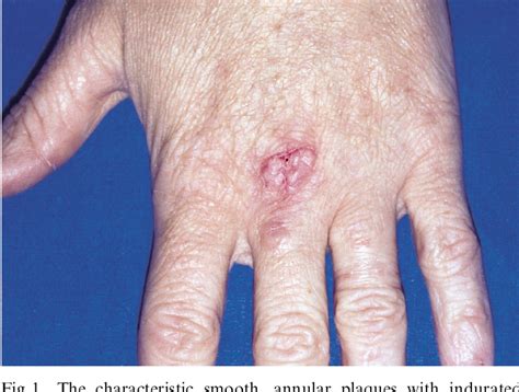 Figure 1 From Granuloma Annulare In The Hand Semantic Scholar