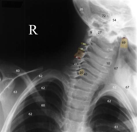 Normal Radiographic Anatomy Of The Cervical Spine Radiology
