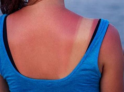 Sunburns Severe Enough To Warrant Admission Described