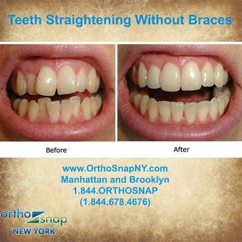 Here's another solution for you!dental boutique is a dent. 144 best images about Straighten Teeth Without Braces on ...