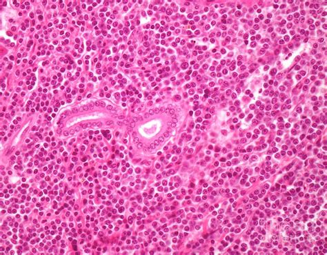 Small Lymphocytic Lymphoma Photograph By Webpathologyscience Photo Library