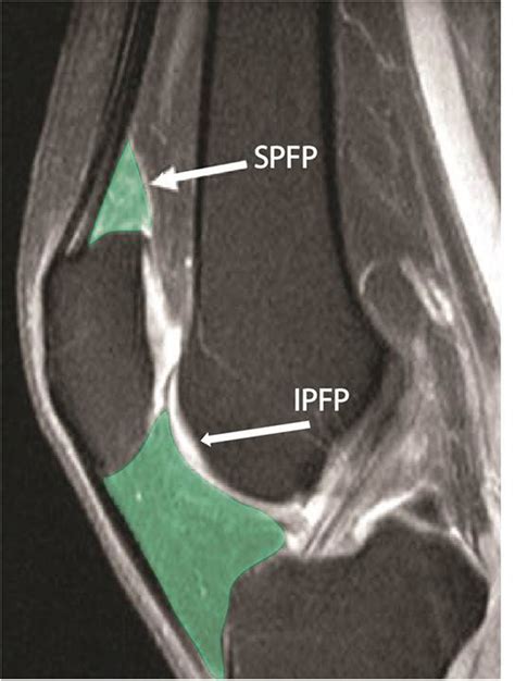 Synovitis Of Knee Joint Fat Pads Is Correlated With Inflammatory