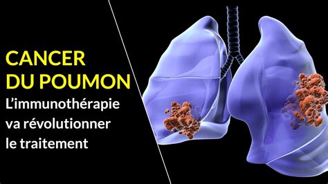 L'immunothérapie et les thérapies ciblées. Cancer du poumon : l'immunothérapie va révolutionner le ...