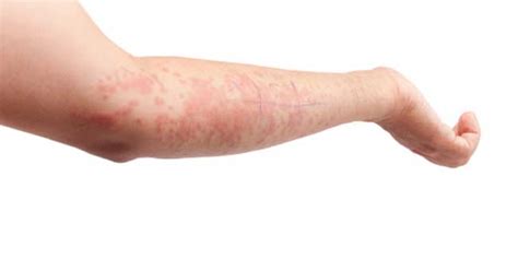 What Is The Prognosis Of Hives Or Urticaria Snr