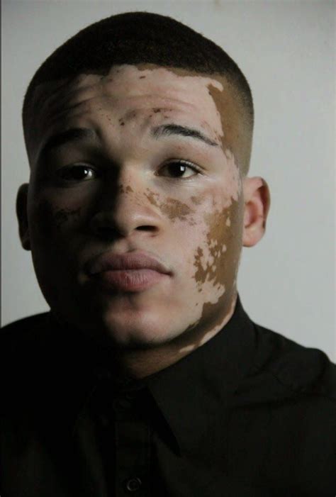 Curtis Mcdaniel Vitiligo Model Vitiligo Draw On Photos
