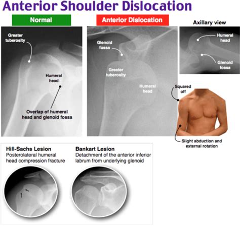Shoulder Dislocation Flashcards Quizlet