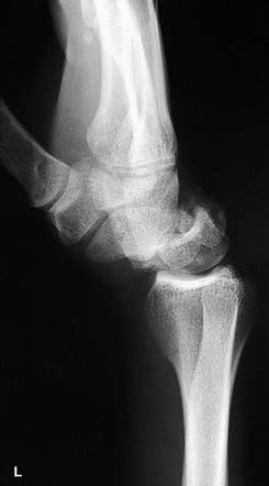 Perilunate Dislocation Radiology Reference Article Radiopaedia Org