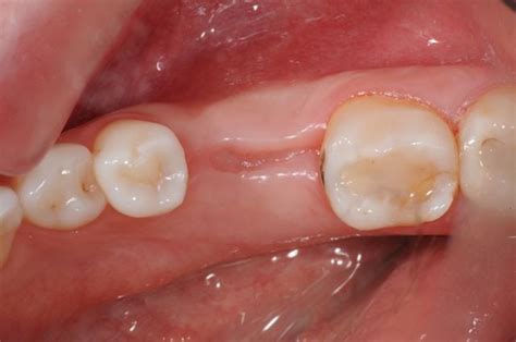 A wisdom tooth extraction is still a surgery, so physical discomfort after the procedure is normal. What is Oral Surgery? | Affiliated Dentists S.C.