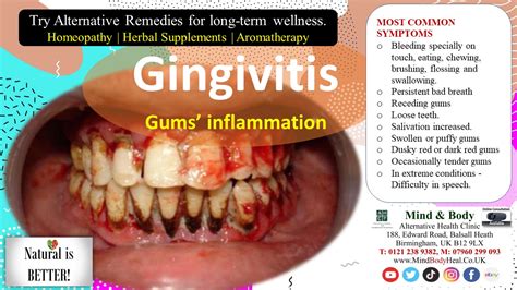 Gingivitis Mind And Body Holistic Health Clinic