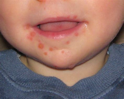 hand foot and mouth disease wikem