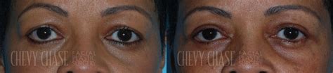 Patient 106387266 Blepharoplasty Before And After Photos Chevy Chase