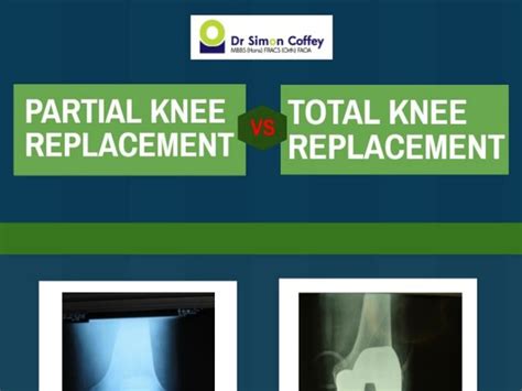 Knee Surgery Knee Replacement Total Knee Replacement A Listly List