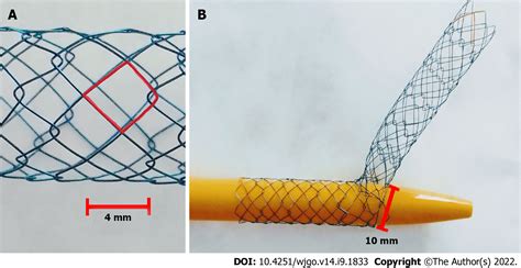 Percutaneous Insertion Of A Novel Dedicated Metal Stent To Treat