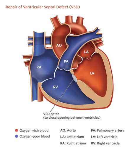 Ventricular Septal Defect Vsd Sujyotheartclinic