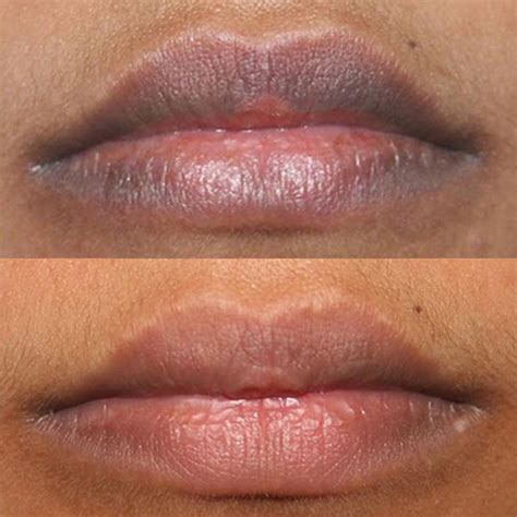 All About Laser Lip Lightening Effects Cost Risks