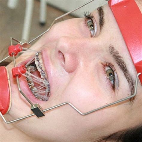 Braces Braceface Metalbraces Girlswithbraces Headgear Facemask Elastics Dental Braces