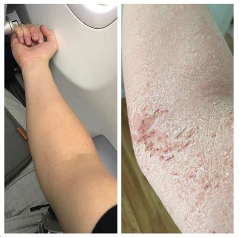 8 Products For Healing Eczema After Quitting Steroid Creams Tsw