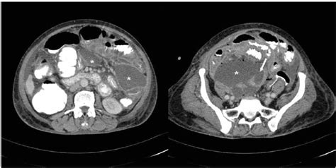 Contrast Enhanced Axial Ct Images Showing Dilated Endometrial Cavity