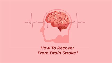 How To Recover From Brain Stroke Doctor Asky
