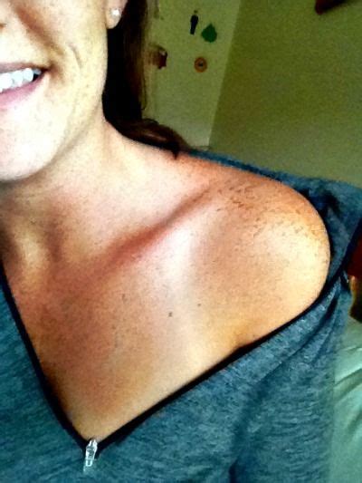 turn your sunburn into a beautiful bronze glow overnight heal sunburn how to tan faster sunburn
