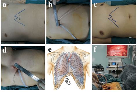 The Incision For Subxiphoid Uniportal Vats Lobectomy A The Transverse