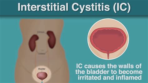 Interstitial Cystitis Causes Symptoms And Treatment My Gynae