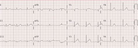 Dr Smiths Ecg Blog Anterior Mi Ongoing Stemi Reperfused Stemi Or
