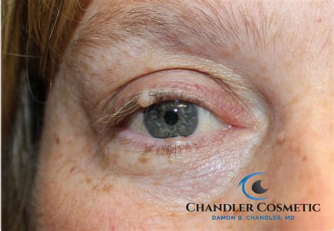 Eyelid Nevus Mole Removal Philadelphia Before And After Photos