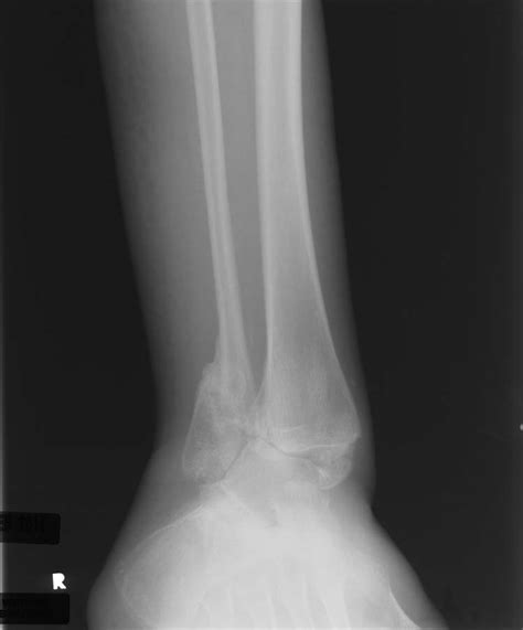 Delayed Reconstruction Of Post Traumatic Ankle Malunion A Case Report