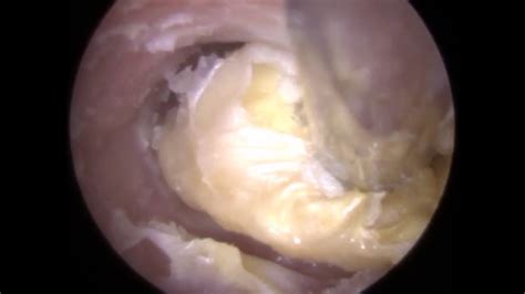 Ear infections symptoms and treatment. What Is The White Flaky Stuff In My Ears - toxoplasmosis