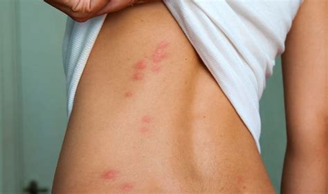 Red Spots That Become ‘raised May Signal Youve Been Bitten By A Bed
