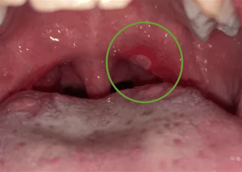 What Does A Canker Sore Look Like Pictures — Canker Shield
