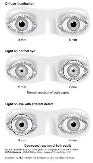 Pupil Size Chart Normal Saadtrax