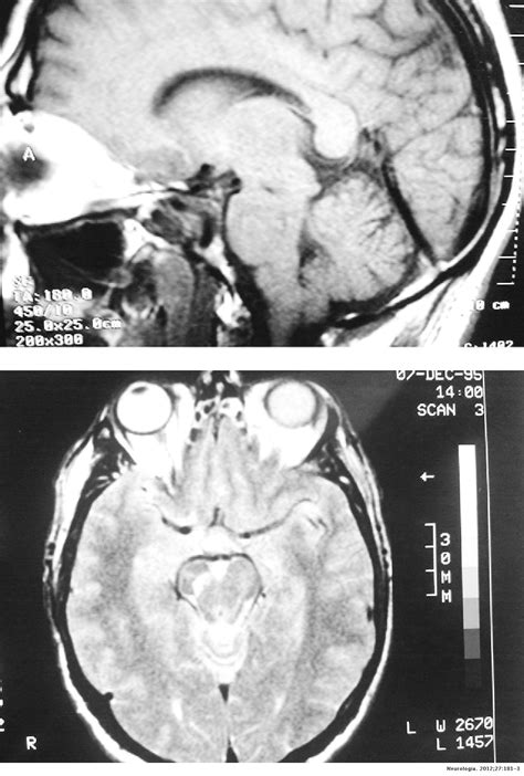 Levodopa Responsive Parkinsonism Dystonia Due To A Traumatic Injury Of